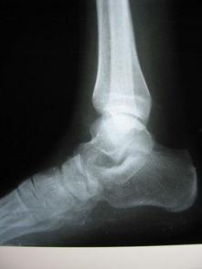 骨坏死照片,骨坏死影像学特征解析与诊断要点